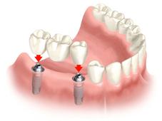 tooth replacement options west auckland